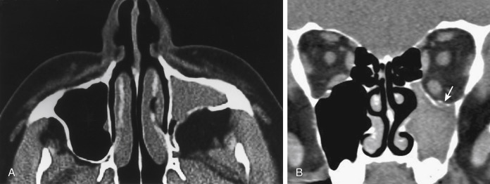 FIGURE 12-9, Silent sinus syndrome. A, Note the retracted posterior wall of the left maxillary antrum. Fat fills the vacuum. The sinus is nearly completely opacified. B, On this coronal computed tomographic image in a different patient, the left maxillary sinus is completely opacified and smaller than the right. Note the slightly thickened walls of the left maxillary sinus from chronic inflammation. The orbital floor of the left is depressed (arrow) compared to the normal right side. The sinus has become “atelectatic.”