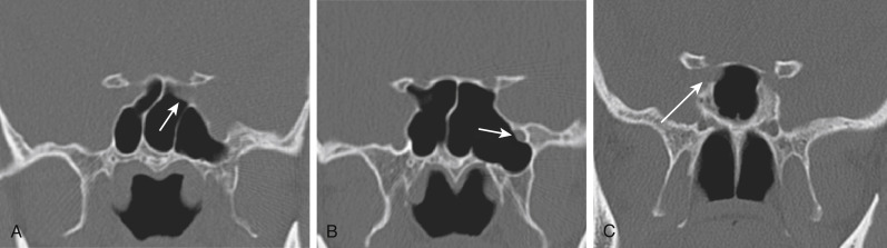 FIGURE 12-10, Potential sites of disaster: dehiscent areas in the sinuses. A, Along the left optic canal in the sphenoid sinus (arrow). B, Along the left maxillary nerve (arrow). C, Along the right optic nerve (arrow).