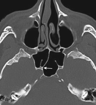 FIGURE 12-11, Sphenoid sinus septa. On this axial computed tomographic image, the right septae in the sphenoid sinus attach to the medial wall of the right internal carotid artery (arrow). Overvigorous removal during sphenoid sinus surgery can cause a laceration in the carotid wall (ouch!).