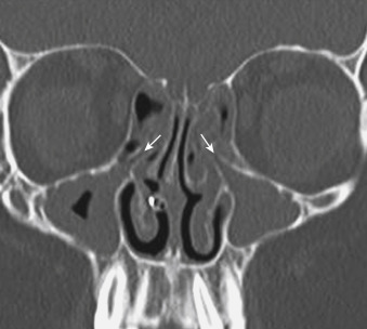 FIGURE 12-12, The ostiomeatal complex in sickness. Note that both maxillary sinus ostia and infundibula (arrows) are opacified in this individual. Associated ethmoid and bilateral maxillary sinus inflammation is present. There is nasal tubing in the right nasal cavity.