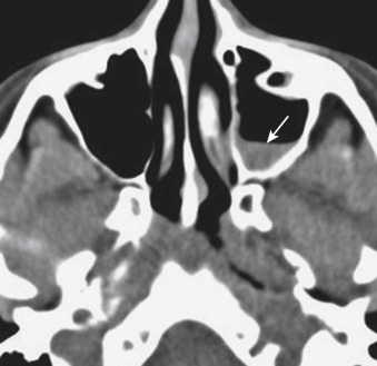 FIGURE 12-13, Acute sinusitis. An air-fluid level can be seen in a number of clinical scenarios, but if the clinician is concerned about acute sinus inflammation, the air-fluid level would be a salient imaging sign (arrow).