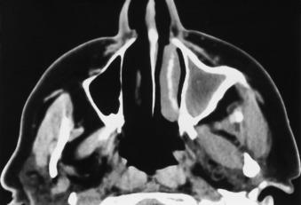 FIGURE 12-14, Chronic sinusitis. Marked bony thickening around the opacified left maxillary sinus signifies osteitis from chronic sinus disease.