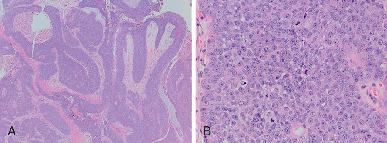 Fig. 19.1, A , Hematoxylin and eosin (H&E) stain 4× : epithelial proliferation demonstrating an endophytic growth pattern characteristic of Schneiderian papilloma, inverted type. B , H&E stain 40× : the epithelial proliferation exhibits a disorganized architecture and the epithelial cells demonstrate frank atypical features including marked pleomorphism, increased nuclear-to-cytoplasmic ratio, prominent nucleoli, increased mitotic activity, and atypical mitotic figures indicative of severe dysplasia.