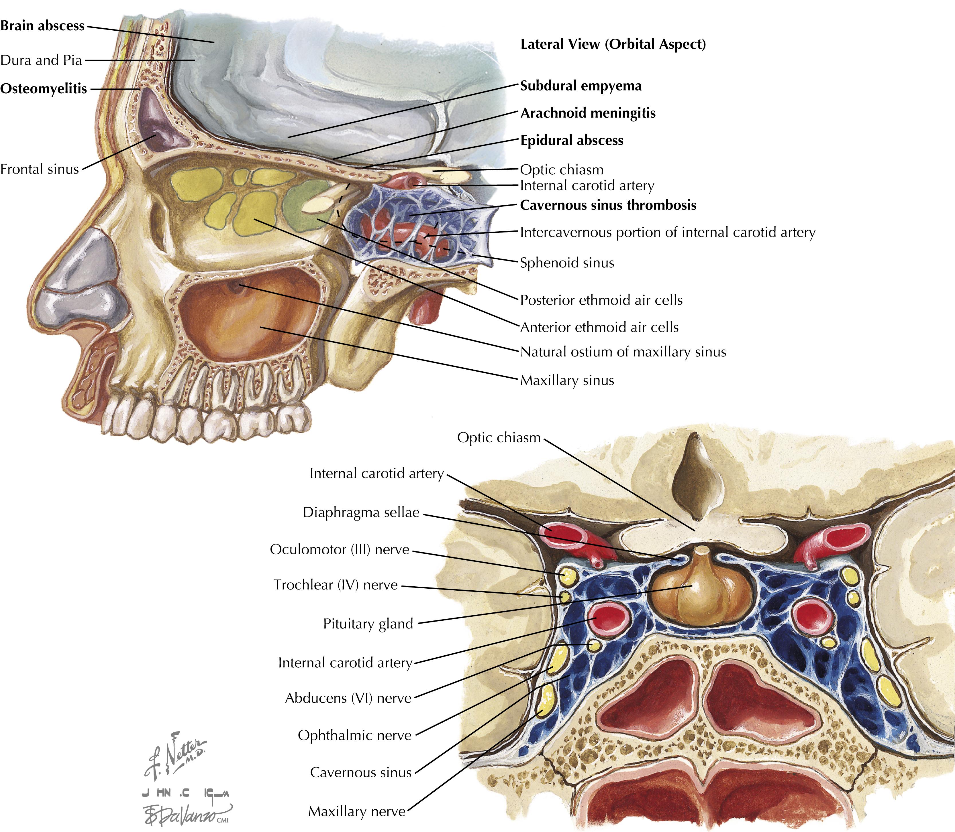 Fig. 31.2, Proximity of the paranasal sinuses to the orbit and intracranial structures; cavernous sinuses.