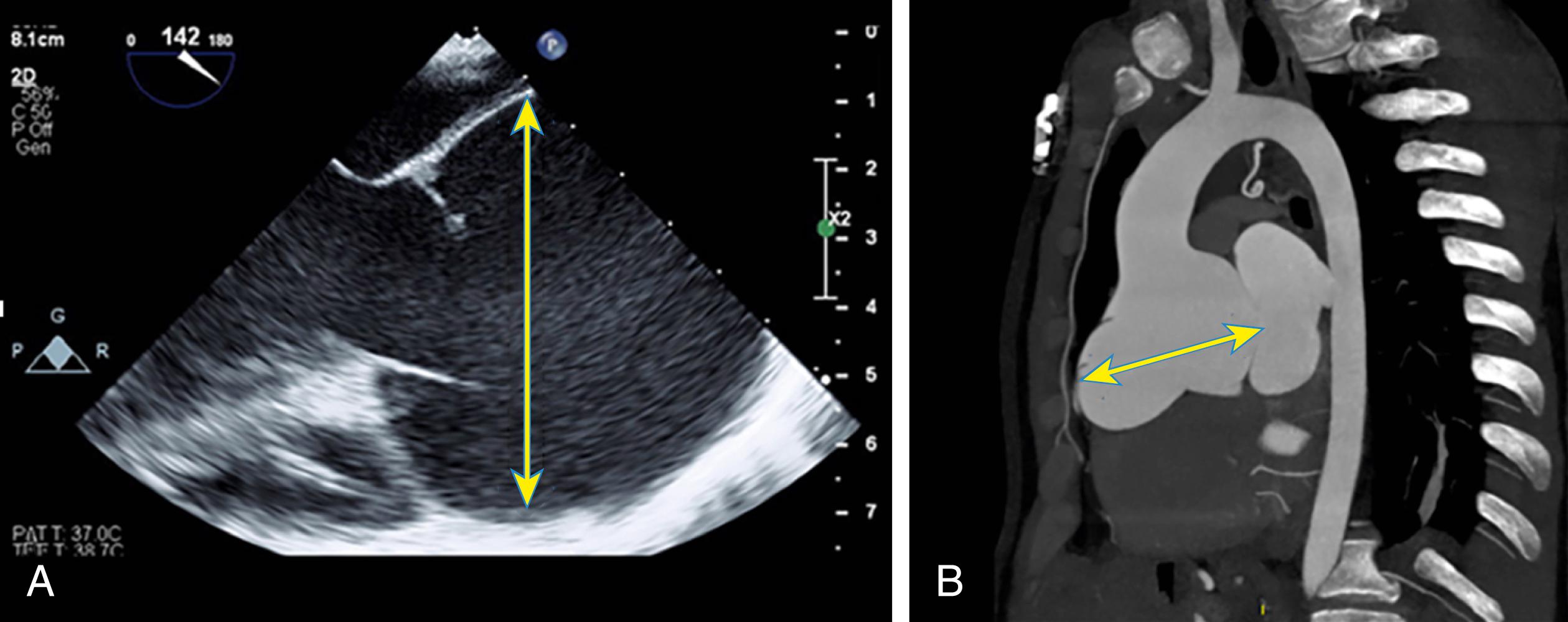 Figure 132.2, Long-axis view of the aortic valve on transesophageal echocardiogram ( A ) in a patient with bicuspid aortic valve and aortic root aneurysm (yellow arrow) . Sagittal view on computed tomography ( B ) of the same patient demonstrating a significantly dilated aortic root (yellow arrow) .