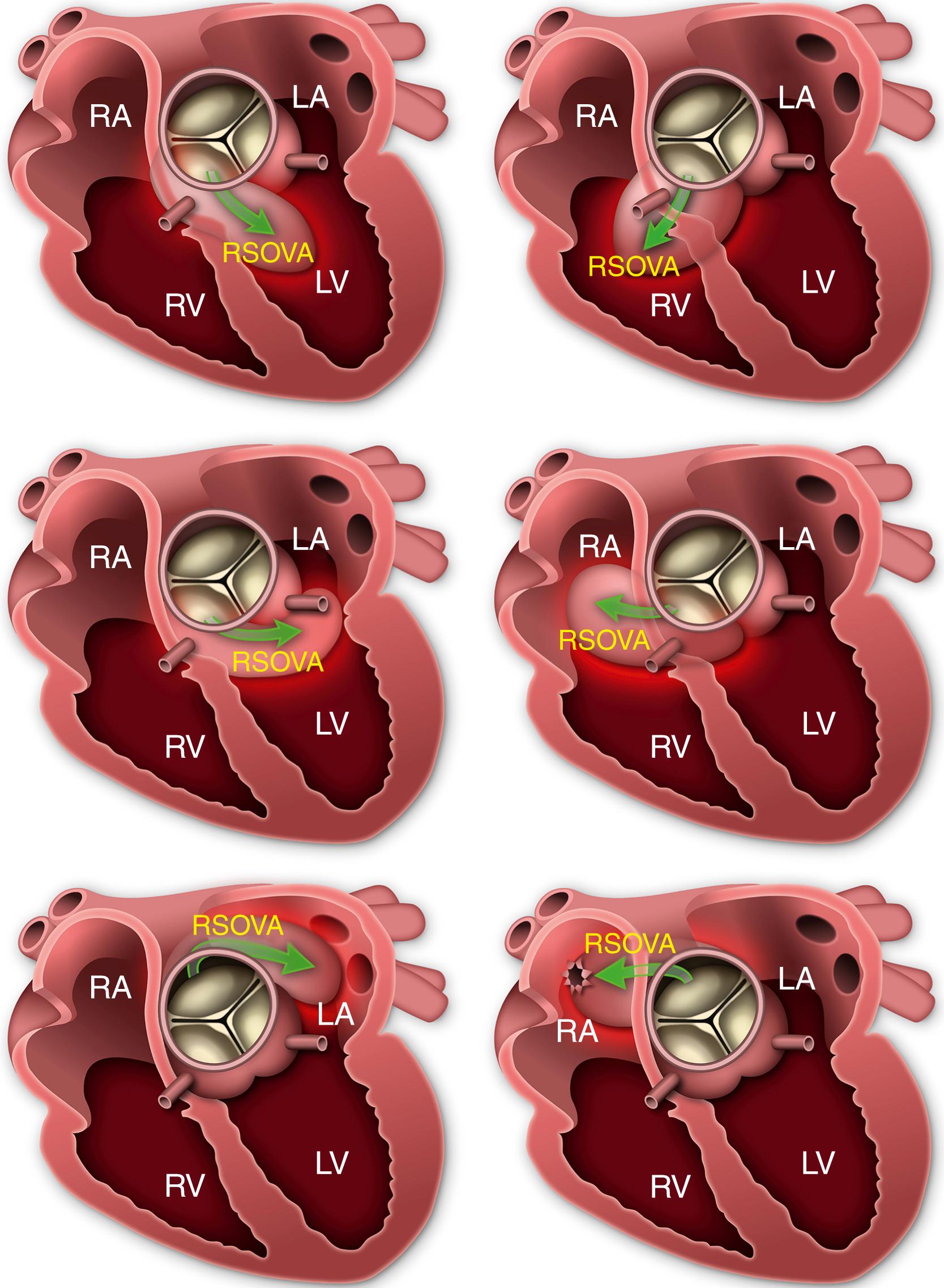 Figure 132.4, Outlines some examples of a right sinus of Valsalva aneurysm (RSOVA) and noncoronary sinus of Valsalva aneurysm (NCSOVA) and putative cardiac chamber into which it may enlarge. Note that the relationship of the SOVA and coronary arteries displays the mechanism for coronary artery compression and angina-type pain or acute coronary syndrome that may result. LA, Left atrium; LV, left ventricle; RA, right atrium; RV, right ventricle.