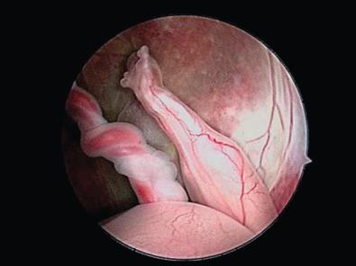 Fig. 144.1, Embryoscopic image of an embryo with sirenomelia. The lower limbs are fused, and the umbilical cord demonstrates a single large umbilical artery.