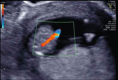 Fig. 144.2, Color Doppler demonstrates a single umbilical artery that appears to arise from the aorta.