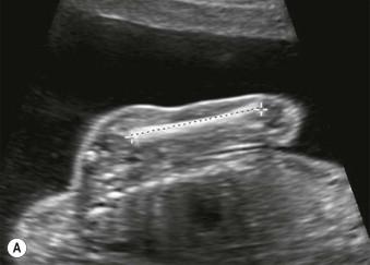 FIGURE 16-3, Normal views of the arm. (A) Humerus; (B) radius and ulna; (C) hand.