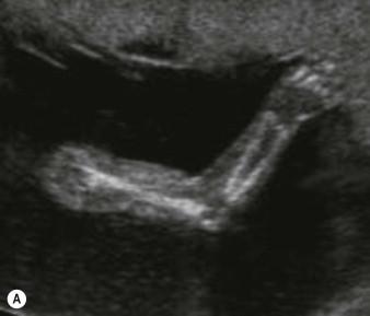 FIGURE 16-4, The normal arm in: (A) flexion; (B) extension.