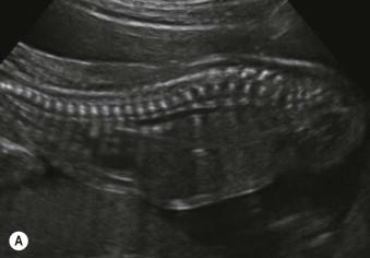 FIGURE 16-7, Sagittal views of the spine in platyspondyly. (A) Thanatophoric dysplasia. (B) Achondroplasia. (C) X-ray of thanatophoric dysplasia.