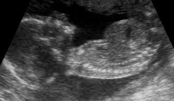 FIGURE 16-8, Sagittal view of a fetus with short rib polydactyly showing thoracic hypoplasia.