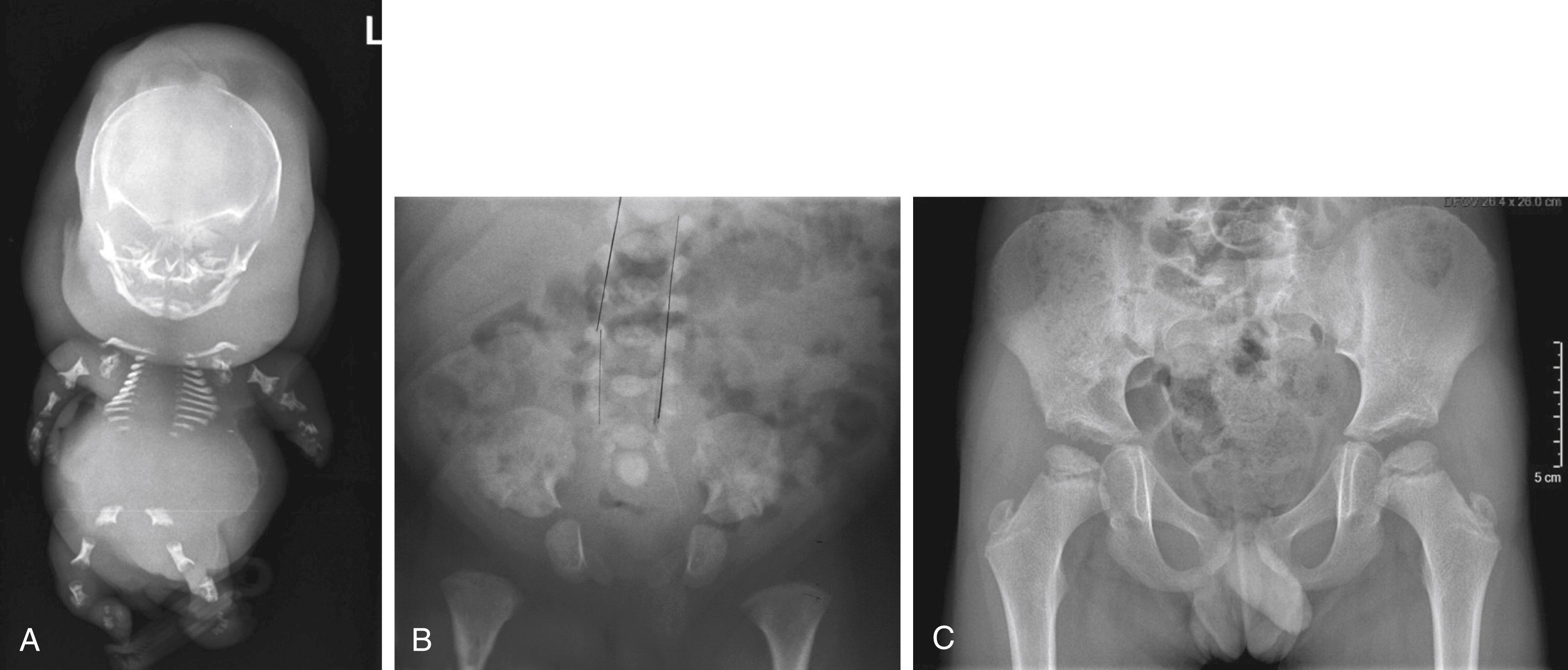 Fig. 49.1, The spectrum of type 2 collagenopathies. A, This fetus has achondrogenesis type 2; the most severe variant of the type 2 disorders. Note the absence of spinal ossification and appearance of a “floating” skull. The small chest size makes this condition lethal. B, This is a pelvis radiograph of a child with the most frequent nonlethal type 2 collagen disorder: spondyloepiphyseal dysplasia congenita (SEDc). There is delayed pubic and epiphyseal ossification and the child has prenatal-onset short stature. Lines indicate the interpediculate distance to differentiate this from the more common achondroplasia (which has decreasing interpediculate distance from L1 to L5). C, This is a pelvis radiograph of a 6-year-old boy with mild bilateral Perthes secondary to a COL2A1 mutation. He has normal height. His mother from whom he inherited the mutation had high myopia.