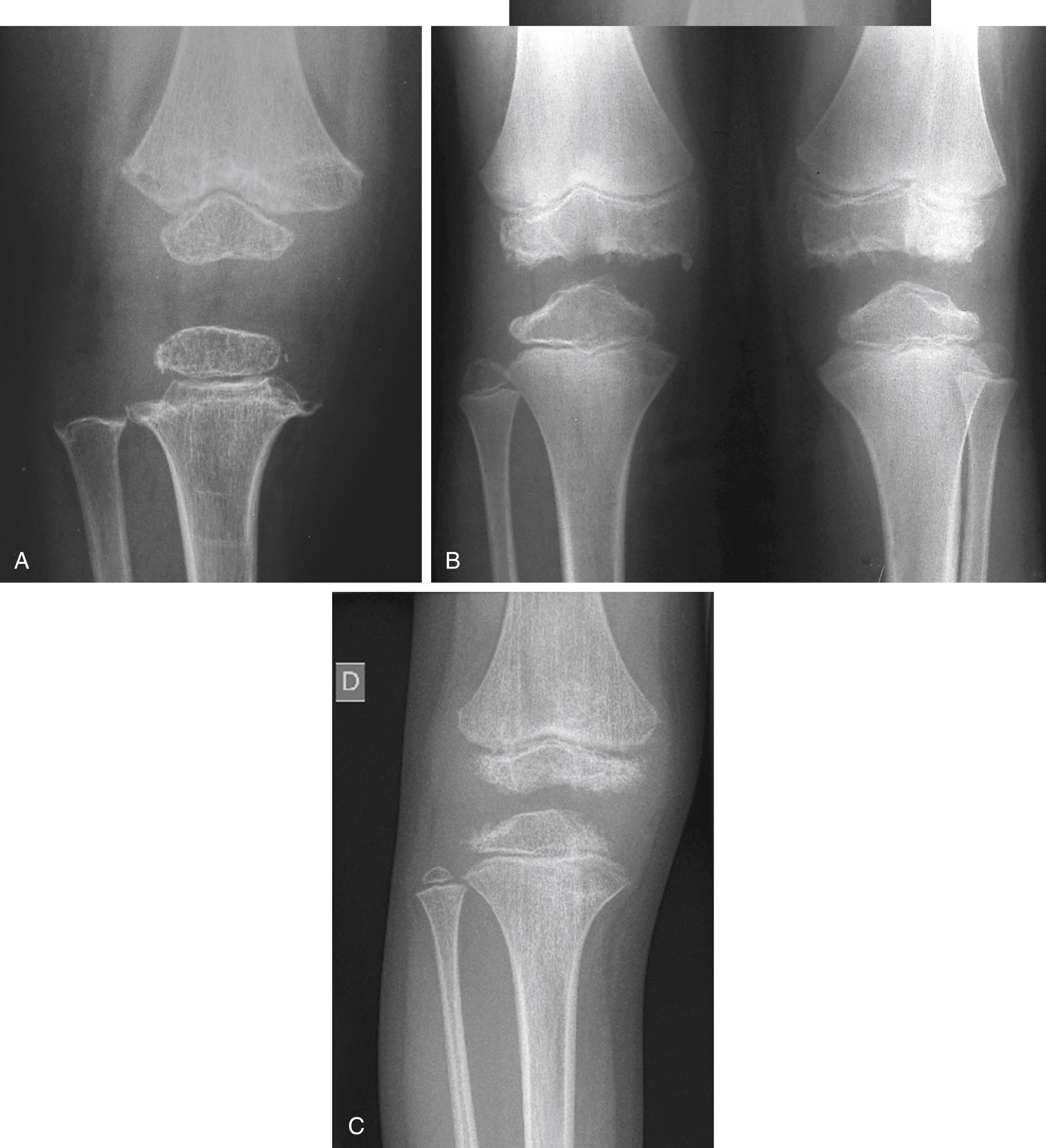 Fig. 49.2, Knee radiographs of a child with multiple epiphyseal dysplasia (MED). A, This child has MED as a result of a COMP mutation (most frequent molecularly defined form). Note the epiphyseal dysplasia with the small epiphyses sitting within the center of a somewhat abnormal metaphysis. B, This child has recessive MED as a result of SLC26A2 mutations. The epiphyses are dysplastic but cover more of the metaphyseal plate than in the COMP mutation affected knee. C, This child has MED as a result of a mutation in MATN3. The epiphyses of the knee are flattened laterally.