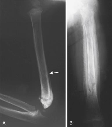Fig. 1.1, (A) Radiograph of a healing supracondylar fracture illustrating the periosteum stripped ( arrow ) to nearly the midshaft of the humerus. The bridging periosteal bone stabilizes this fracture in about 3 weeks. (B) The large periosteal involucrum surrounds the former bone (sequestrum) in a femur with osteomyelitis. The periosteum can be stimulated to remanufacture an entire cortex around this area, such that when the sequestered bone is removed, the periosteal bone will form a new (larger-diameter) femoral diaphysis.