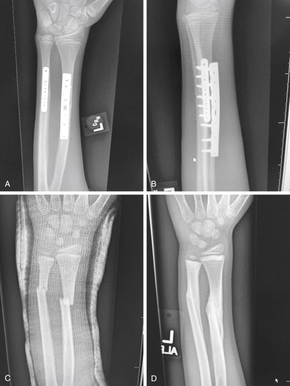 Fig. 1.2, Anteroposterior (A) and lateral (B) radiographs of a forearm in a 15-year-old male who underwent open reduction and internal fixation with plates/screws. The fracture healing demonstrates primary bone healing with rigid fixation. An anteroposterior radiograph of a forearm in a 5-year-old at the time of original cast immobilization (C) and at 10 weeks (D) with complete fracture union demonstrates secondary bone healing. The motion that occurs with secondary bone healing results in abundant callus formation.