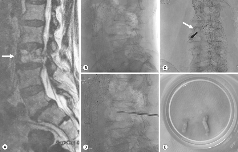 Fig. 87.1, Fluoroscopically Guided Transpedicular Biopsy of the L3 Vertebral Body.