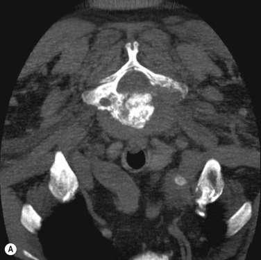 Fig. 87.2, Computed Tomography (CT)-Guided Transpedicular Biopsy of the C7 Vertebral Body.