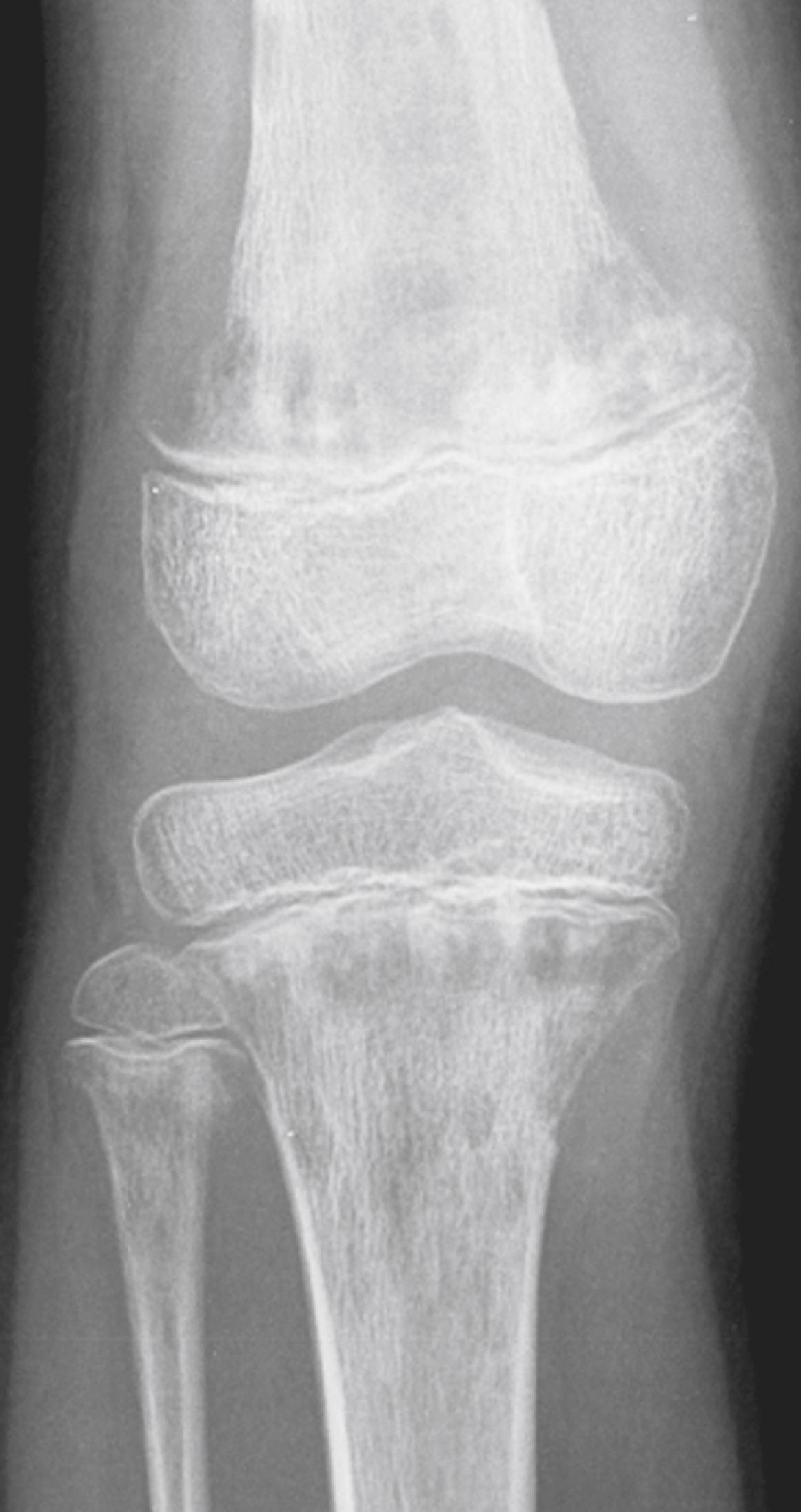 Fig. 47.1, Acute lymphoblastic leukemia: Metaphyseal lucencies of the right femur, tibia, and fibula in a 5-year-old girl.
