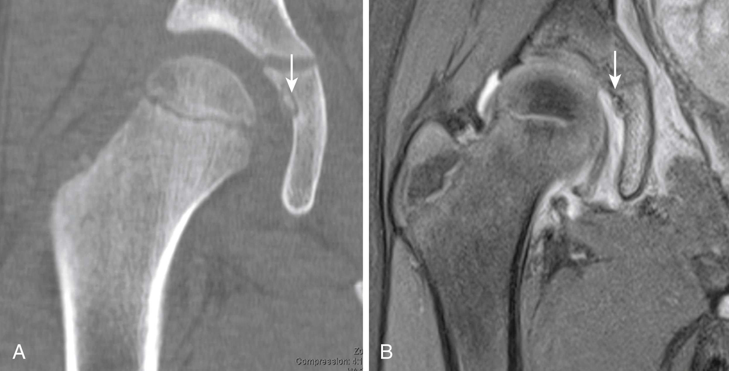 Fig. 47.2, Osteoid osteoma: Lesion in right acetabulum in a 7-year-old boy. A, Computed tomography (CT) demonstrates nidus of lesion ( arrow ). B, Magnetic resonance imaging (MRI) of same lesion demonstrates extensive adjacent bone and soft tissue reaction. ( arrow )