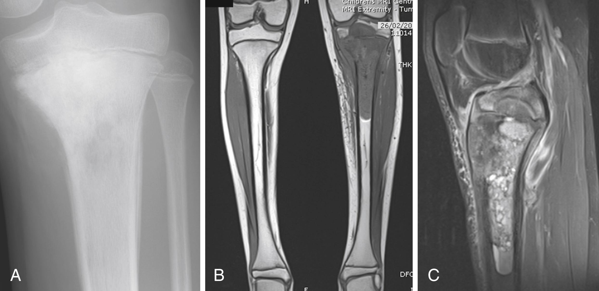 Fig. 47.3, Osteosarcoma of left proximal tibia in an 11-year-old boy. A, plain radiograph shows cortical breach with periosteal reaction. B, T1 sequences on magnetic resonance imaging (MRI). C, T2 sequences on MRI.