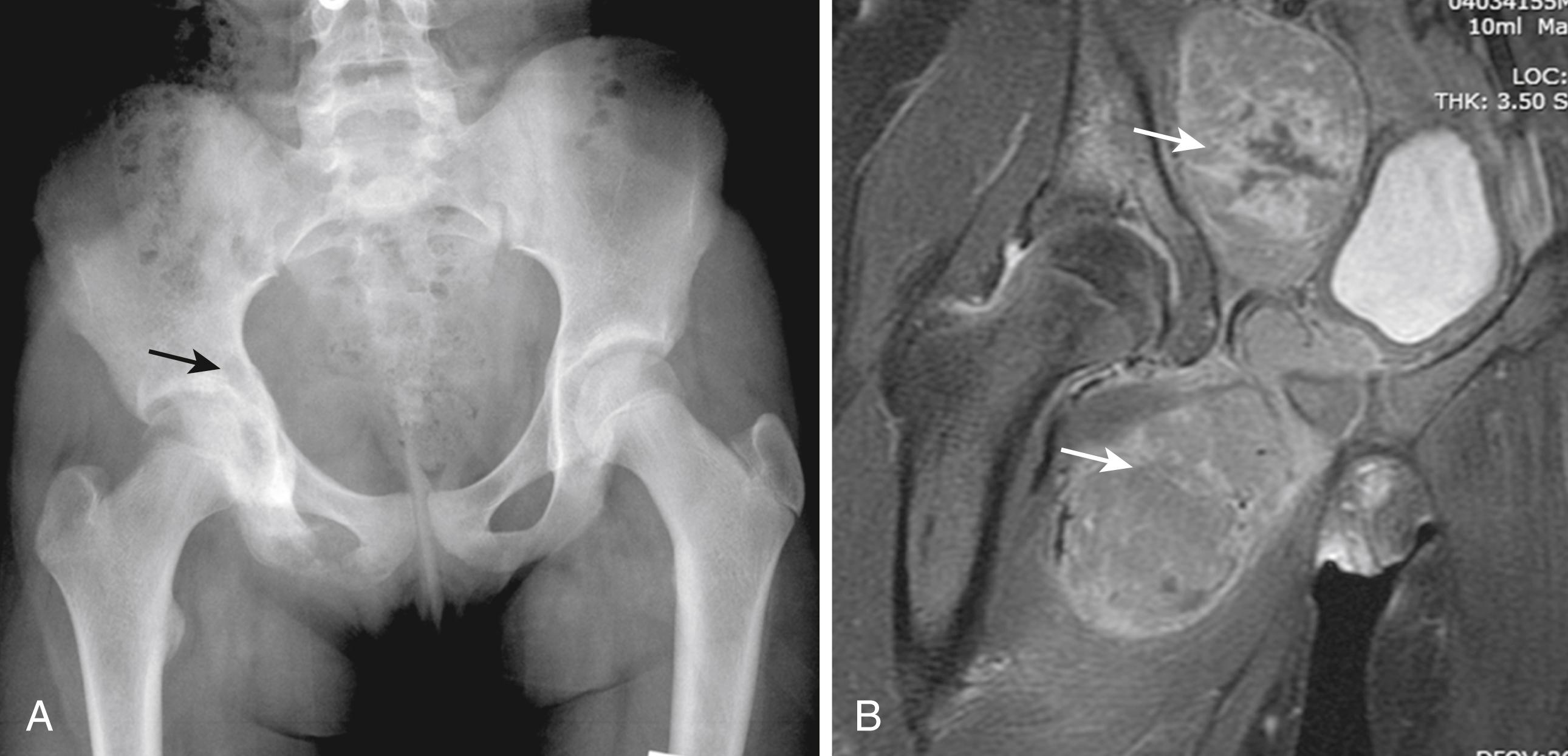 Fig. 47.4, Ewing sarcoma of the right ischium in a 12-year-old boy. A, Plain radiograph demonstrates lytic lesion. B, Magnetic resonance imaging (MRI) indicates extent of soft tissue tumor mass.