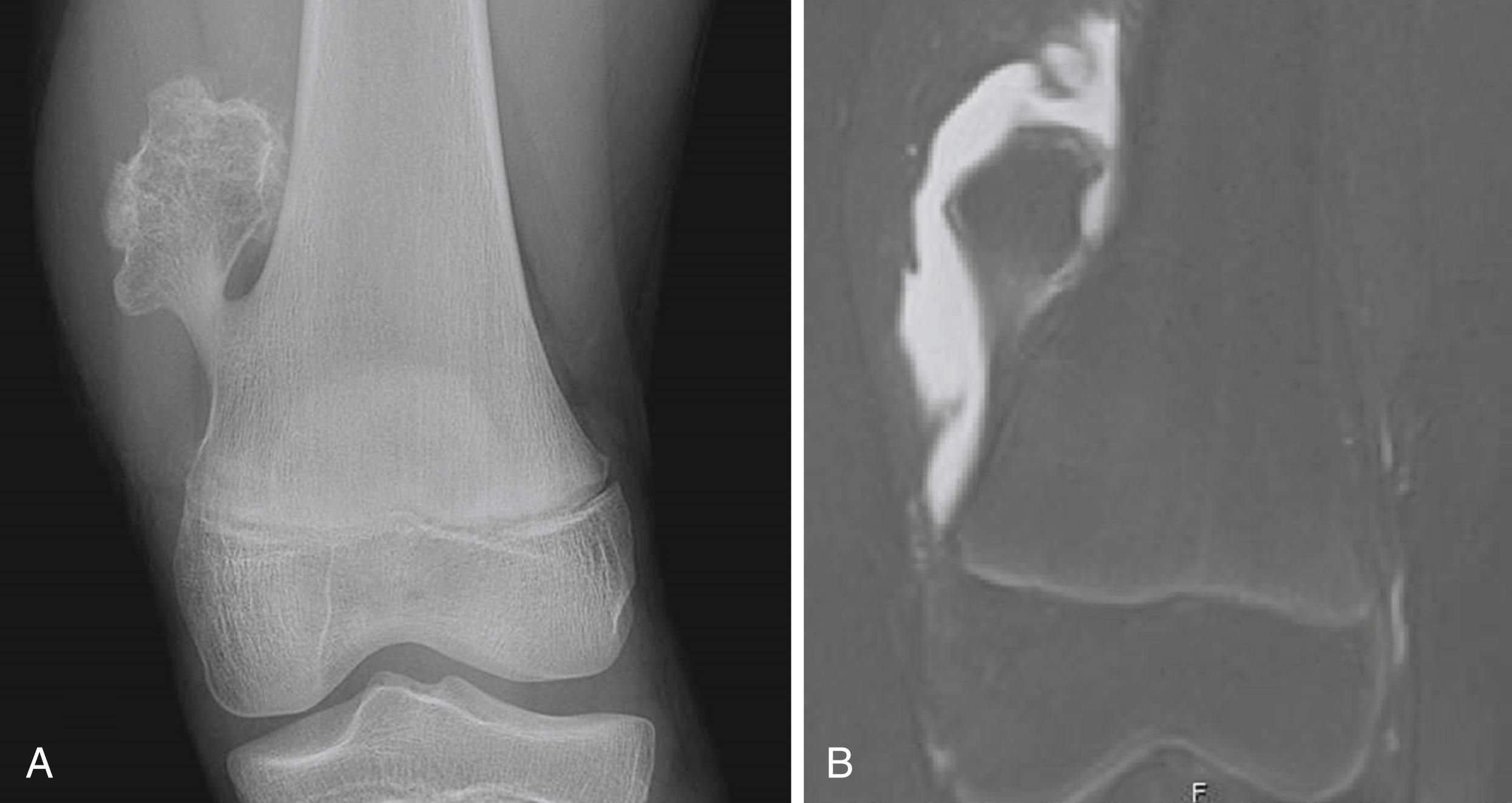 Fig. 47.5, Osteochondroma of left femur in an 11-year-old boy. A, Plain radiograph demonstrates pedunculated lesion. B. T2-weighted magnetic resonance imaging (MRI) demonstrates presence of an associated bursa.