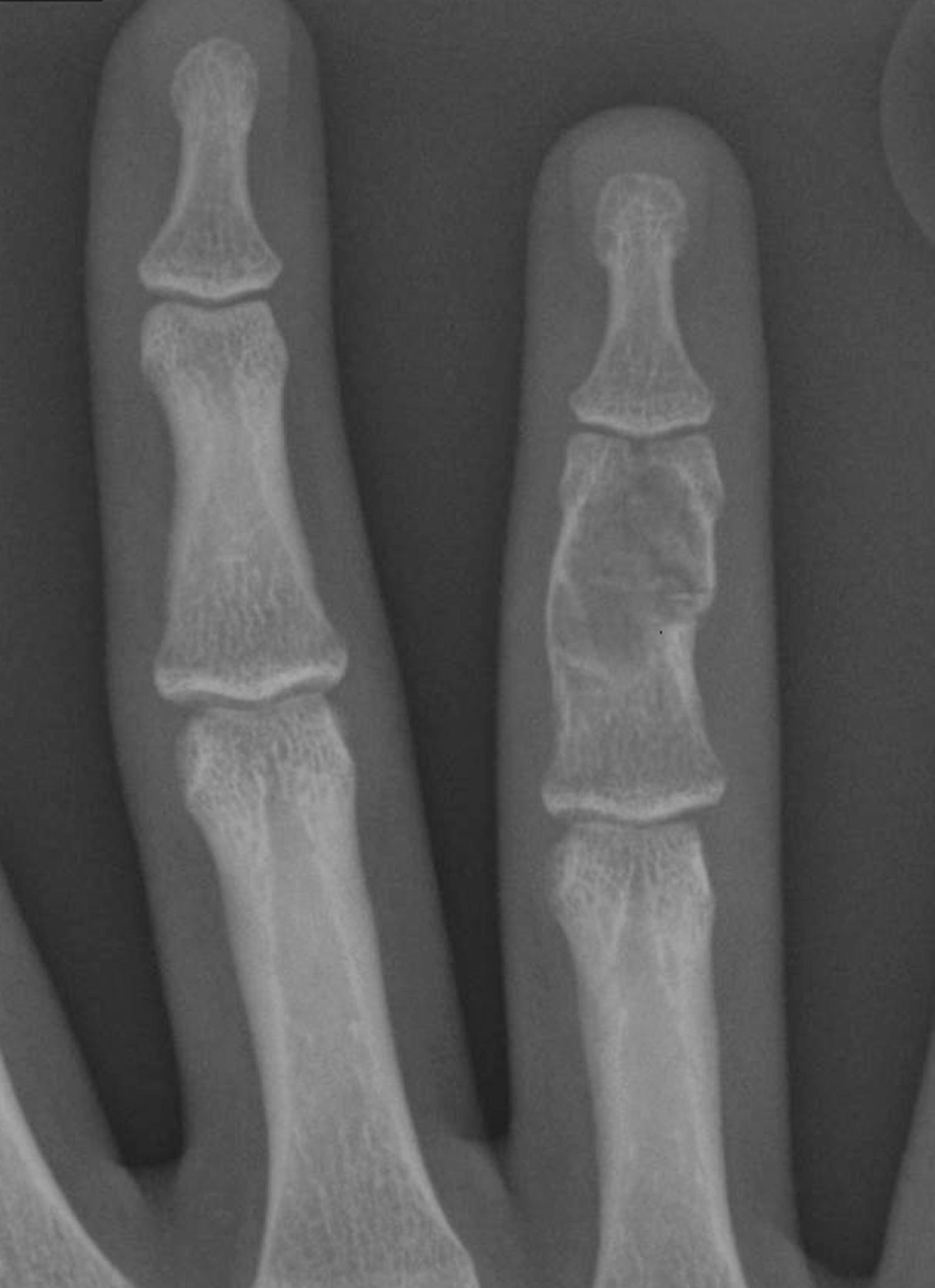 Fig. 47.6, Enchondroma of middle phalanx in a 15-year-old girl with no involvement of the interphalangeal joint.