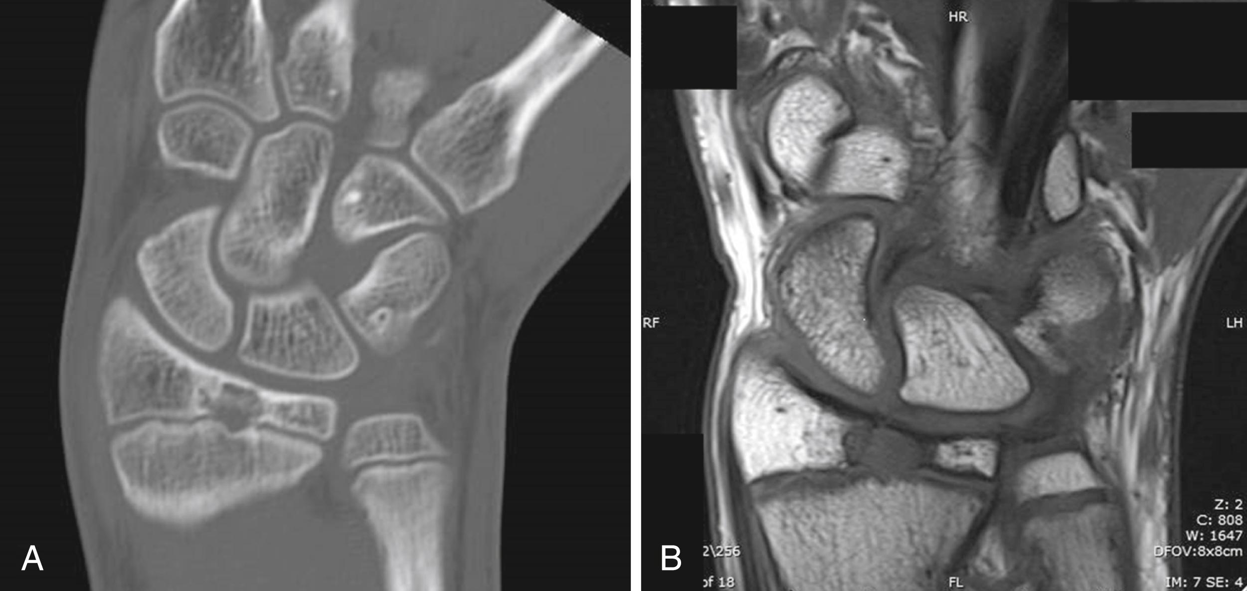 Fig. 47.7, Chondroblastoma of left radial epiphysis in a 14-year-old girl. A, Computed tomography (CT) and ( B ) magnetic resonance imaging (MRI) showing lack of any bone edema or inflammatory reaction.