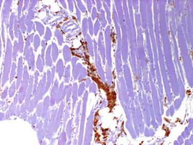 Fig 4, Dermatomyositis. This immunohistochemical study illustrates that T lymphocytes are primarily of the CD-4 type.