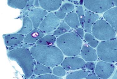 Fig 2, Inclusion body myositis. Gomori trichrome stain reveals rimmed vacuoles.