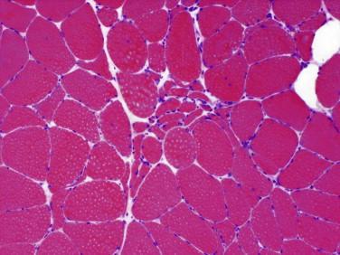 Fig 7, Neurogenic features. H&E stain shows small groups of small, angulated myofibers (small group atrophy).