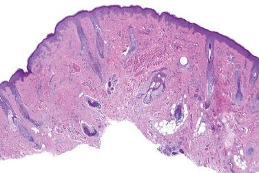 Fig. 1, Rhabdomyomatous mesenchymal hamartoma.