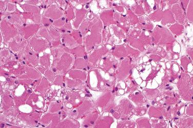 Fig. 2, Adult rhabdomyoma.