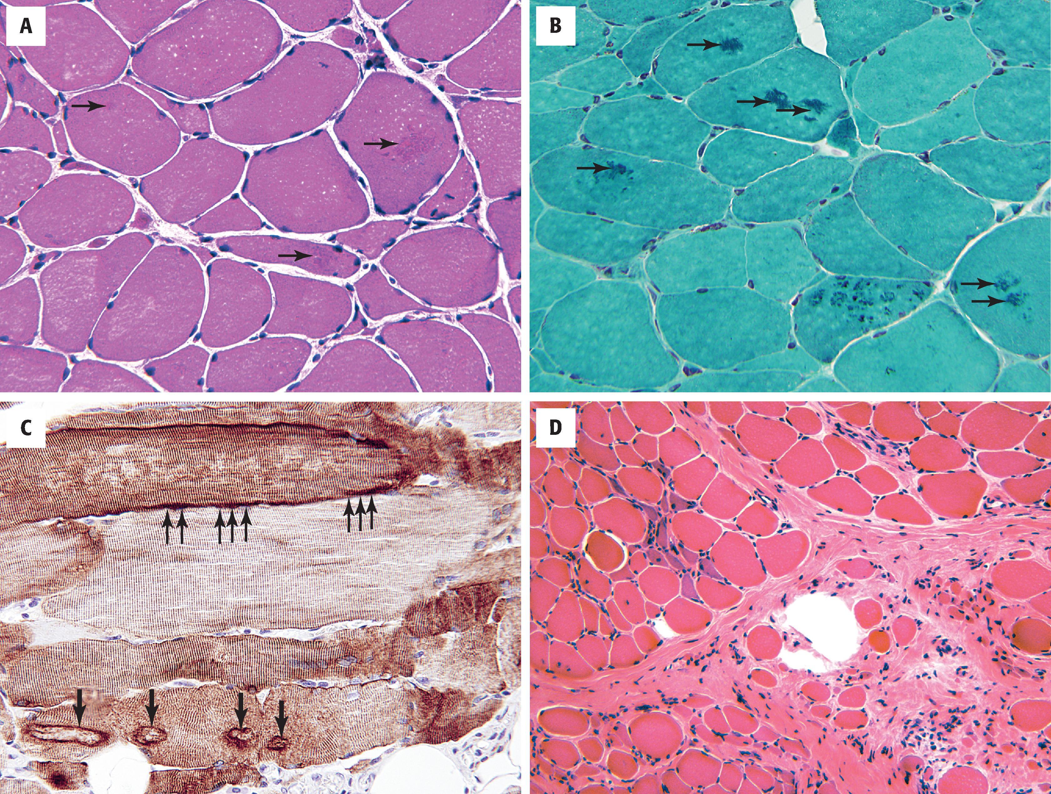 Figure 11.4, A , Similar to late-onset myofibrillar myopathies, desminopathies show myopathic features accompanied by a variety of cytoplasmic aggregates ( arrows ). B , A variety of sarcoplasmic inclusions may be seen on trichrome staining. These are often bluish-green and may be discrete or more rarefied ( arrows ). C , Desmin immunohistochemical staining shows both discrete intracytoplasmic inclusions ( lower arrows ) and more diffuse plaque-like subsarcolemmal aggregates ( upper arrows ). D , Classically, muscular dystrophies demonstrate myopathic features accompanied by prominent endomysial and perimysial fibrosis.