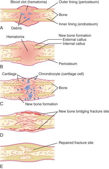 e-Figure 142.1, Stages of fracture healing.