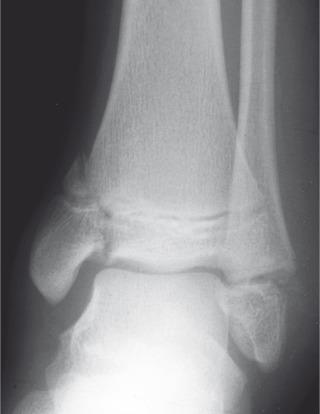 e-Figure 142.11, Salter-Harris IV fracture of the distal tibia in a 13-year-old boy who fell from a tree.