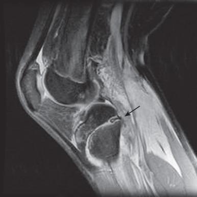 Figure 142.12, Salter-Harris I fracture of the proximal tibia with trapped periosteum in an adolescent.