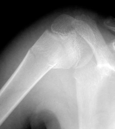 e-Figure 142.13, Incomplete fracture of the proximal humeral metaphysis in a 9-year-old girl.