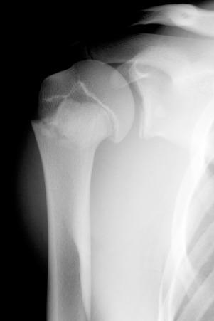 e-Figure 142.14, Salter-Harris II fracture of the proximal humerus in an adolescent.