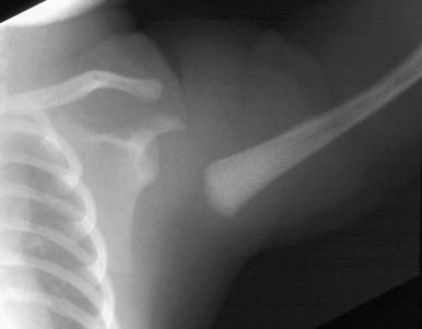 e-Figure 142.15, Proximal humeral Salter-Harris I fracture in a newborn caused by birth trauma.