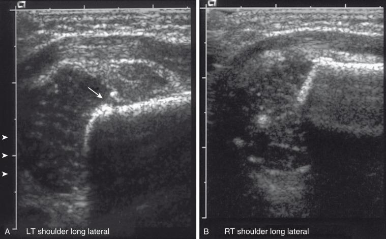 e-Figure 142.16, Proximal left humeral fracture in a 16-day-old girl with decreased arm movement and normal radiograph.