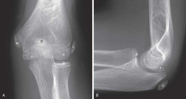 Figure 142.17, Normal elbow in a 14-year-old boy.