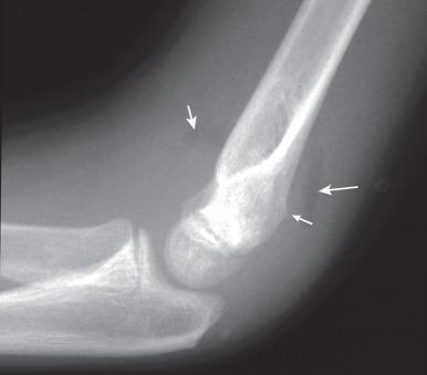 Figure 142.18, Buckle-type supracondylar fracture (small arrow) in a 6-year-old boy.