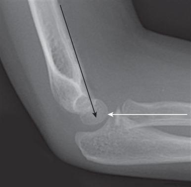 Figure 142.19, Normal elbow alignment on a lateral radiograph.