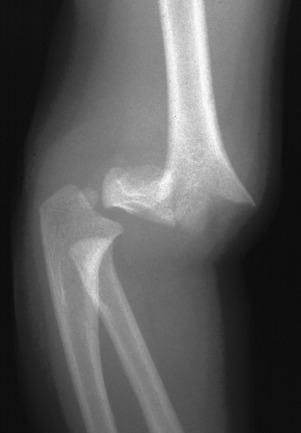 e-Figure 142.20, Supracondylar fracture in a 2-year-old boy.