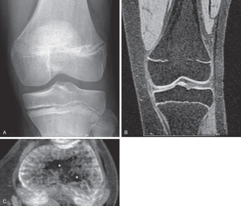 Figure 142.2, Premature growth plate fusion.