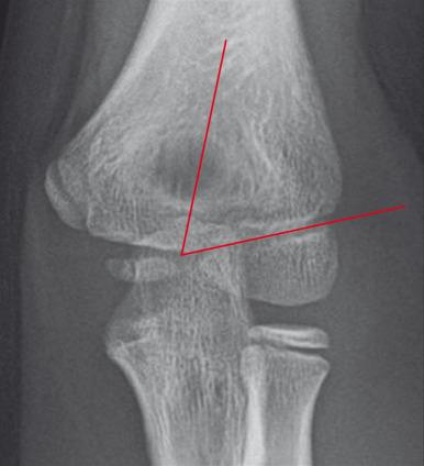 e-Figure 142.21, Normal elbow of a 10-year-old boy demonstrating a normal Bauman's angle.