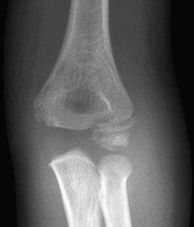 Figure 142.23, Nondisplaced lateral condylar fracture in a 6-year-old boy.