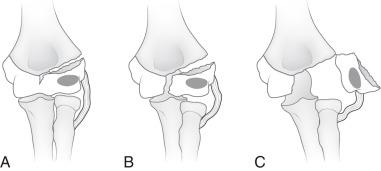 e-Figure 142.22, Classification of lateral condylar fractures according to the amount of displacement.